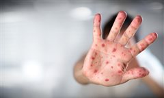 3.065 τα κρούσματα Ιλαράς