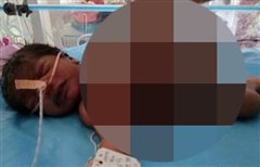 ΣΟΚ - Μωράκι γεννήθηκε με το νεκρό αδερφάκι του να είναι μέσα του!